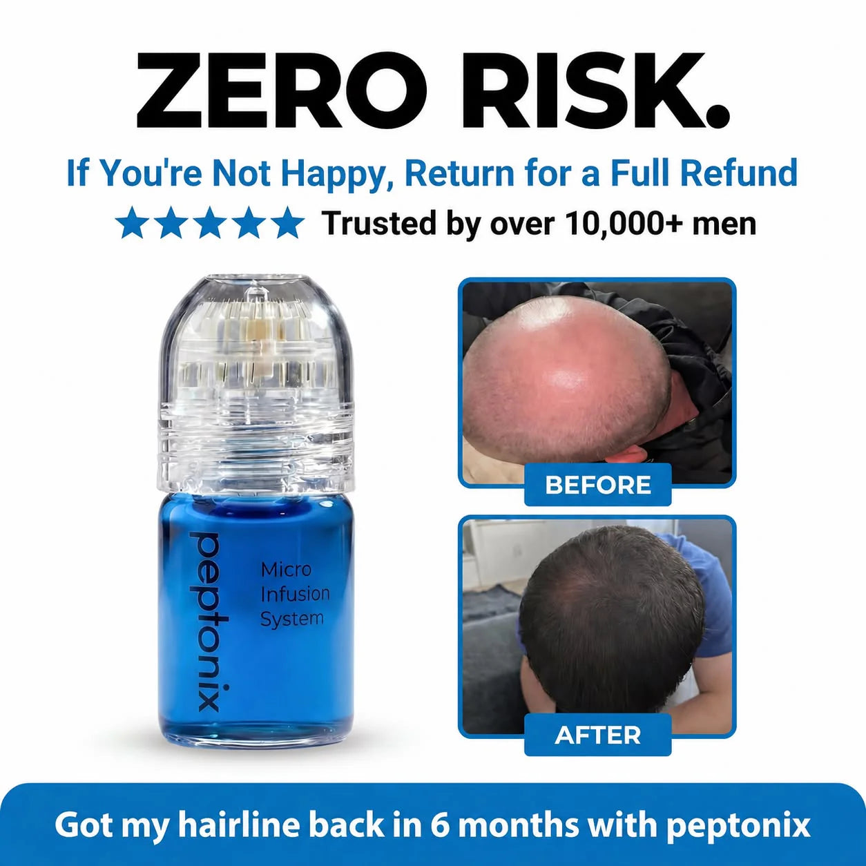 Peptonix - The Most Powerful Peptide Infusion  Hair Regrowth System