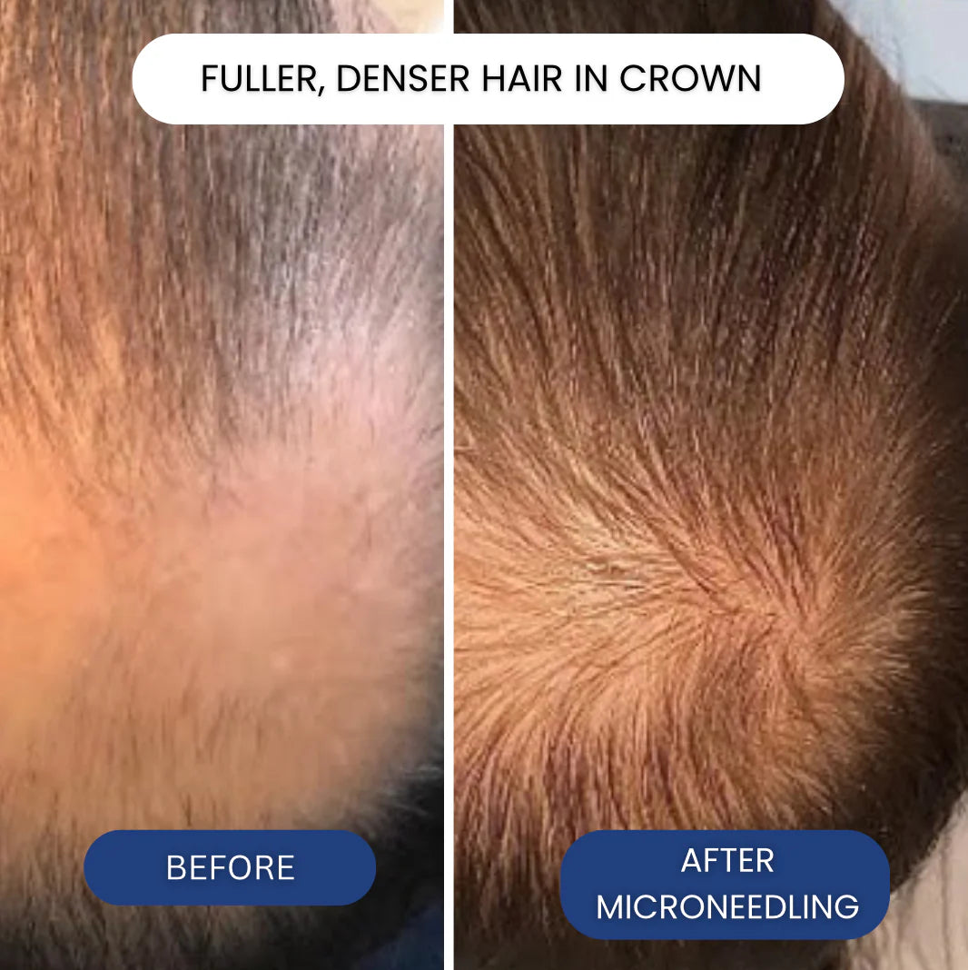 Peptonix - The Most Powerful Peptide Infusion  Hair Regrowth System
